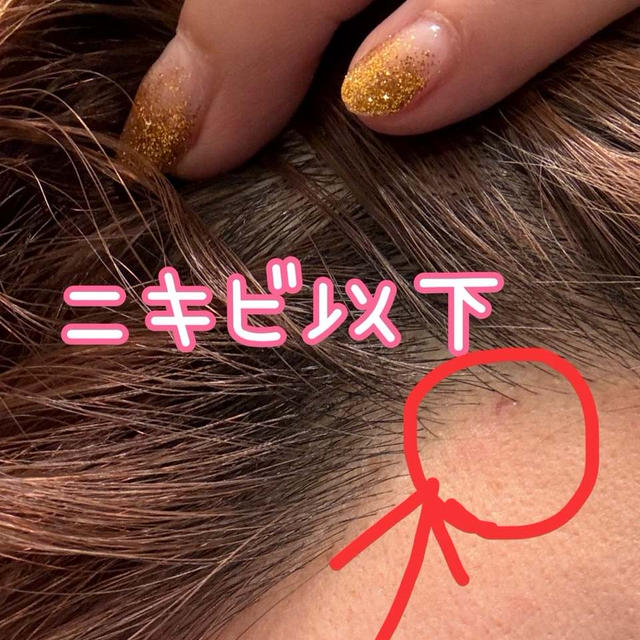 糸リフトとエラボトックスの7日目の様子