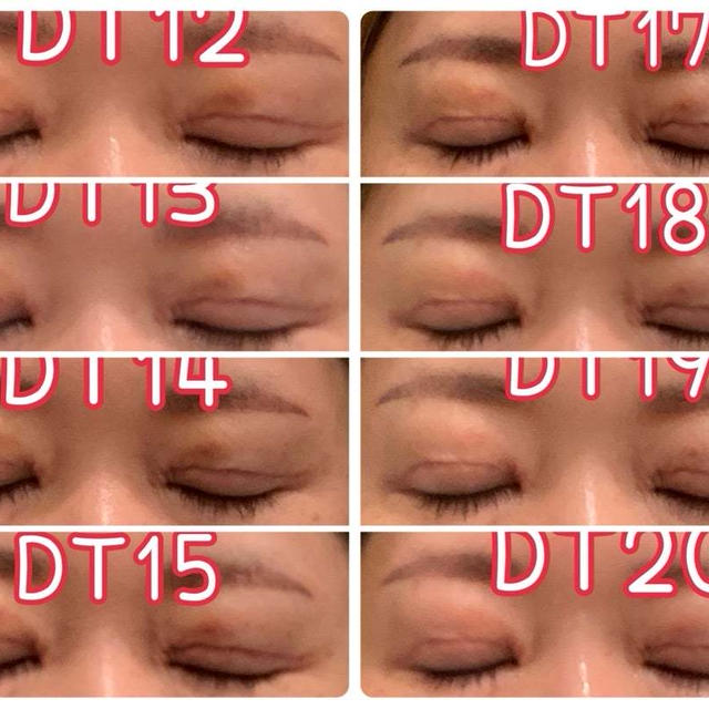 【眼瞼下垂、二重切開レポ】二重整形手術DT14日目～21日目
