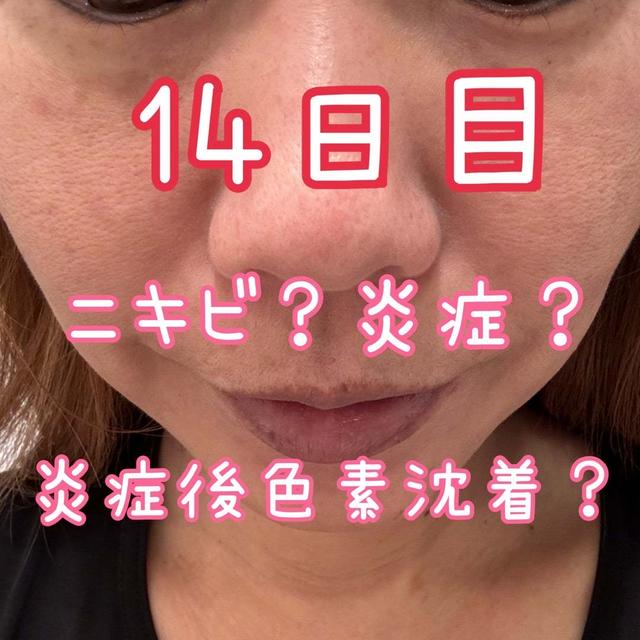 最終レポ♡ニキビだけではなく炎症後色素沈着？♡全顔シミ取りレーザー14日目のレポ