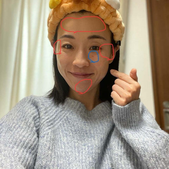 絶対老けたくない！アラフォーママの悪あがき！ボトックス・ビフォーアフター